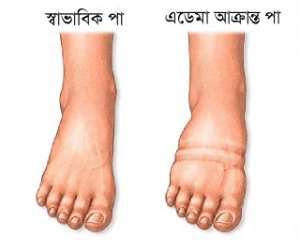 edema-affected-feet